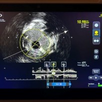 new integrated intravascular ultrasound (IVUS) technology system