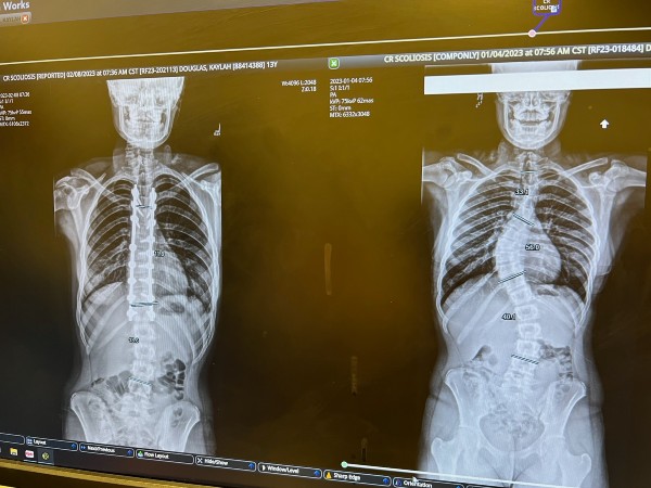 patient scoliosis xray 