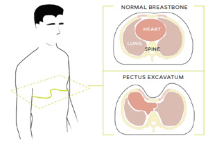 Dylan pectus cross section 2 