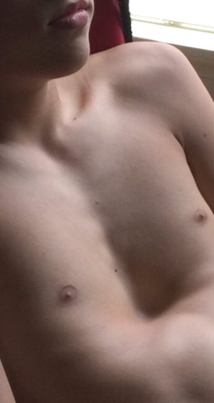 Gage Pectus Excavatum Pre Op