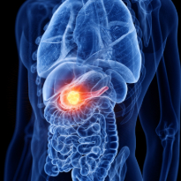 Minimally Invasive Pancreas Cancer Treatment 