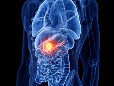 Minimally Invasive Pancreas Cancer Treatmet