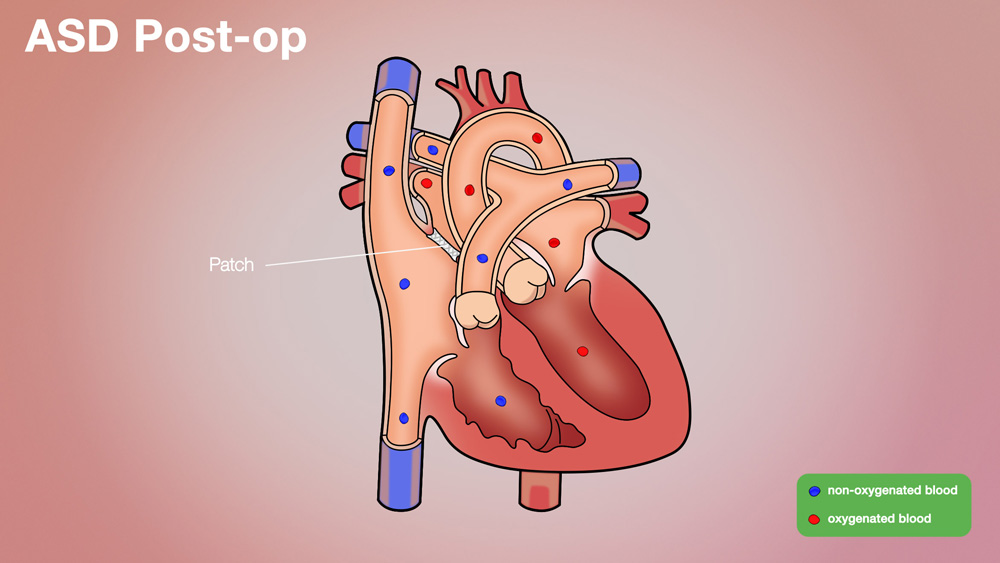 ASD Post-op Anatomical Heart