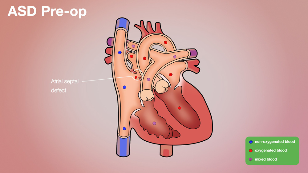 ASD Pre-op Anatomical Heart