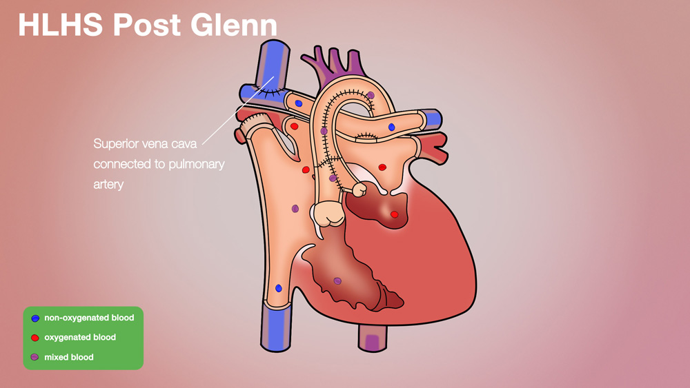 HLHS Post-Glenn Anatomical Heart