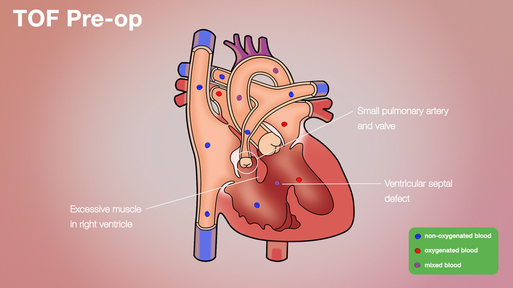 TOF Pre-op Anatomical Heart