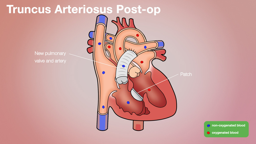 Truncus Post-op Anatomical Heart