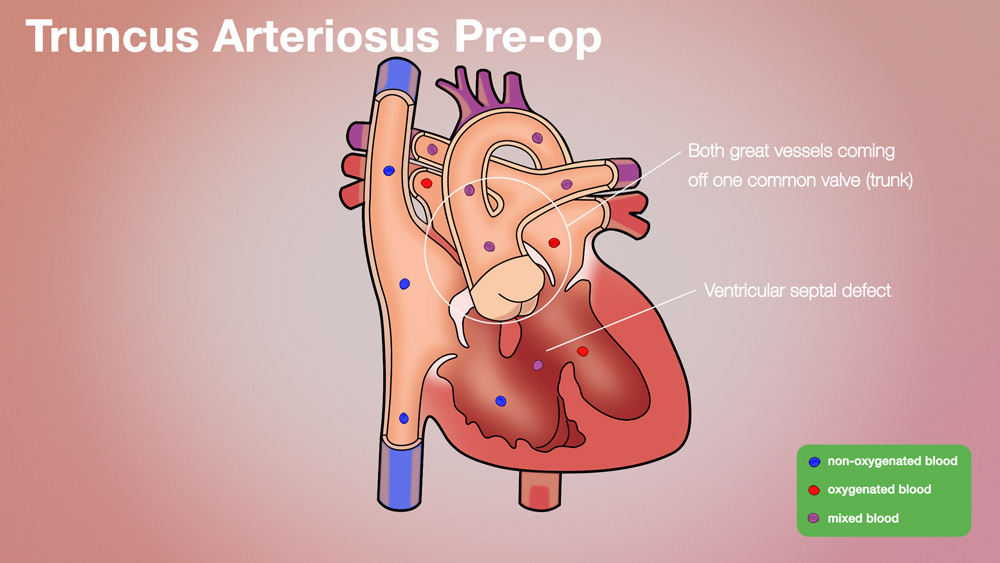 Truncus Pre-op Anatomical Heart