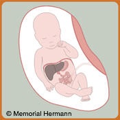 Pediatric Duodenal Artesia Fetus Illustration