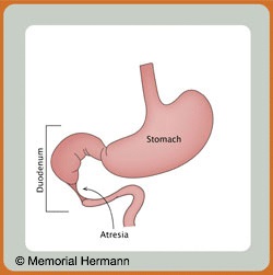 Pediatric Duodenal Atresia Stomach Illustration