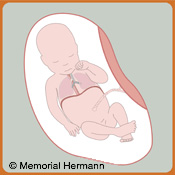 Esophageal Atresia 