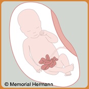 Gastroschisis Fetus Illustration