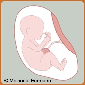 Omphalocele Fetus Illustration