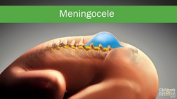 Spin Bifida Meningocele