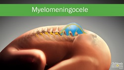 Spina Bifida Myelomeningocele