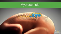 Spina Bifida Myeloschisis