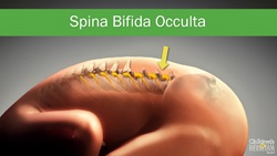 Spina Bifida Occulta