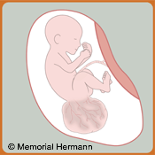 Sacrococcygeal Teratoma Fetus Illustration