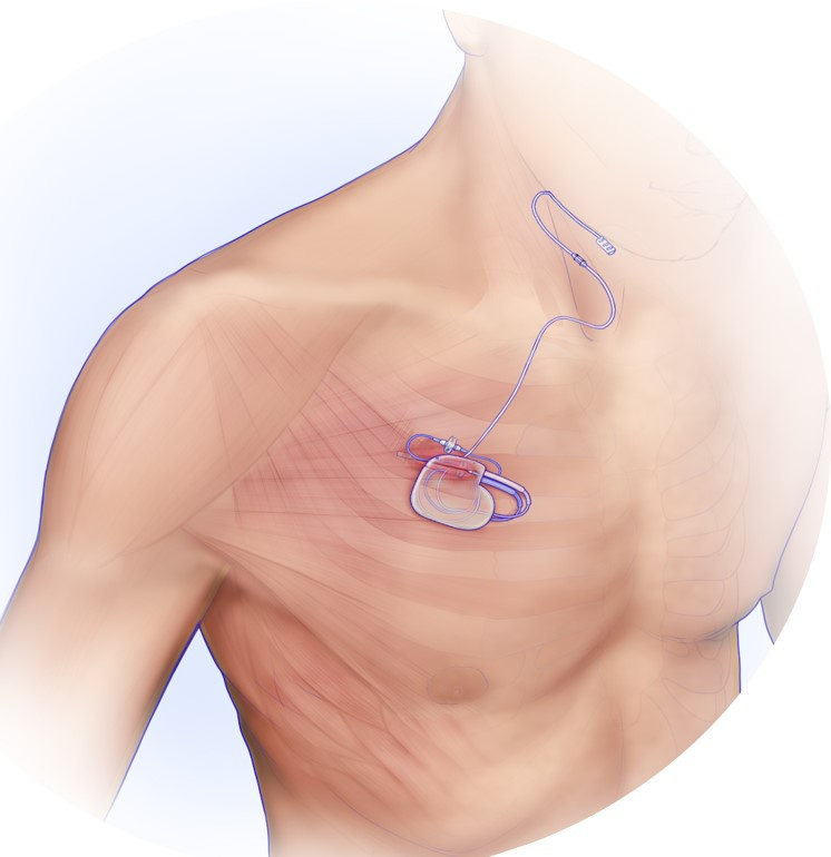 Inspire Procedure Upper Airway Stimulation For Sleep Apnea Memorial   Inspire Device How It Works.ashx